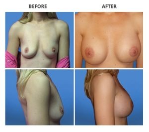Breast Implants by Rejuuuuve4You 2