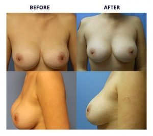 Breast Implants by Rejuuuuve4You 3