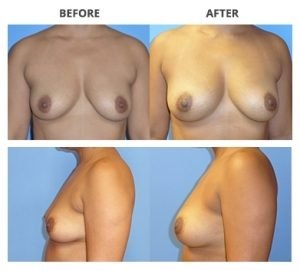 Breast Implants by Rejuuuuve4You 4