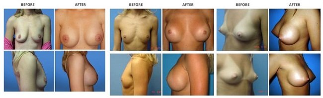 breast augmentation by dr. roche row 1