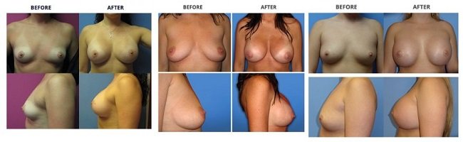 breast augmentation by dr. roche row 2