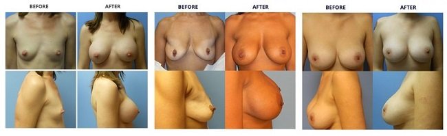 breast augmentation by dr. roche row 3