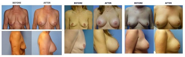 breast augmentation by dr. roche row 4