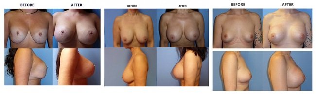 breast augmentation by dr. roche row 5