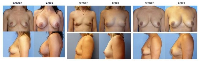 breast augmentation by dr. roche row 6
