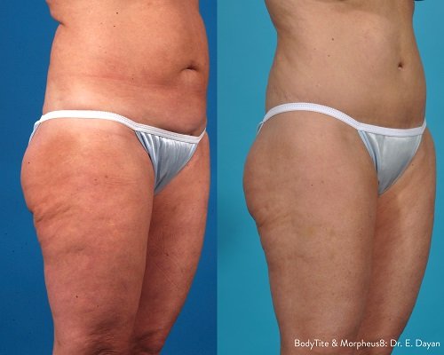 Morpheus8 Body Treatment