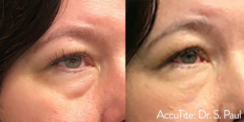 AccuTite Lower Eye Lid