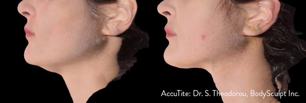 AccuTite Side