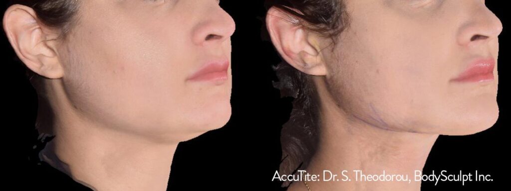 AccuTite before and after