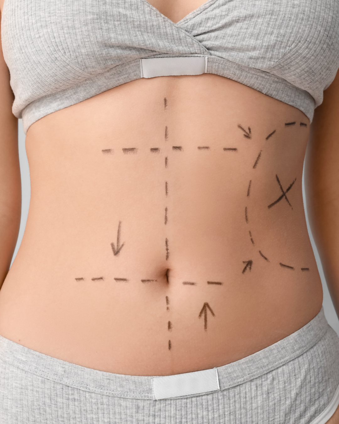 Full Abdominalplasty