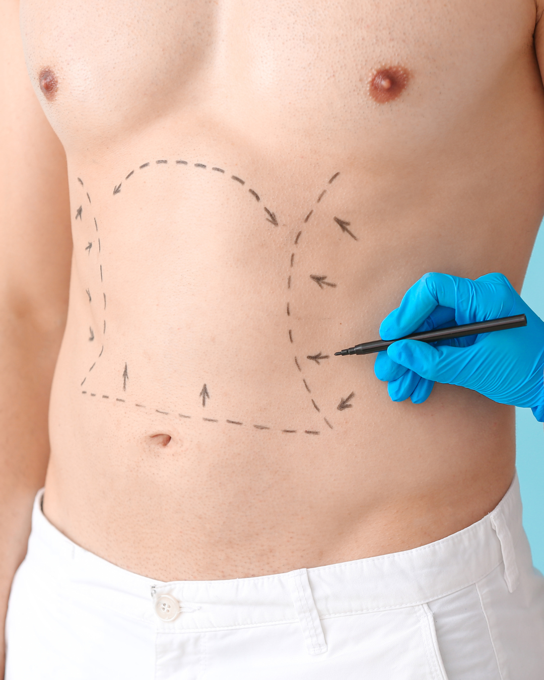 Liposuction