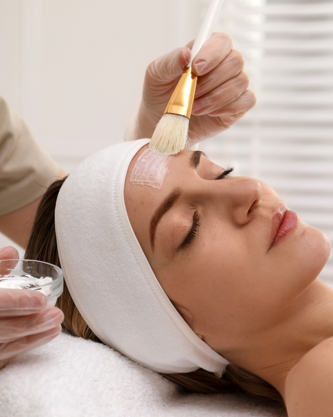 Chemical Peels