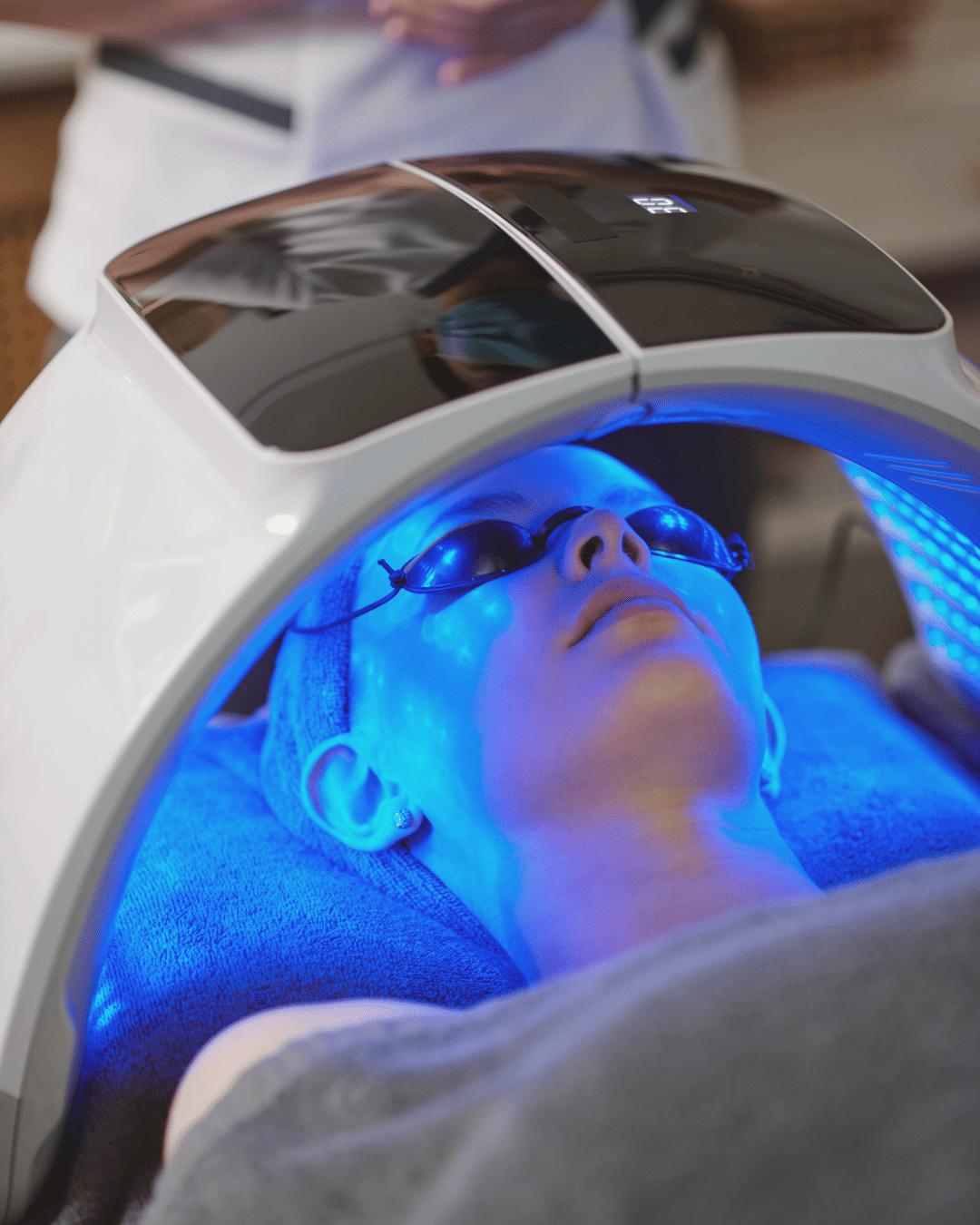 Laser Acne Treatment