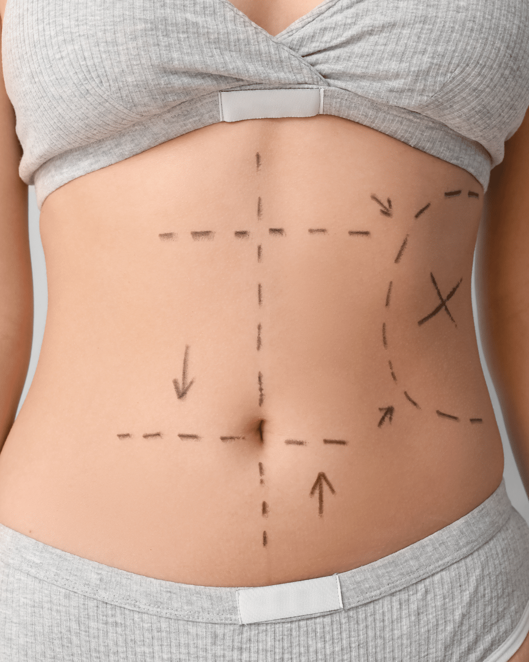 Full Abdominalplasty