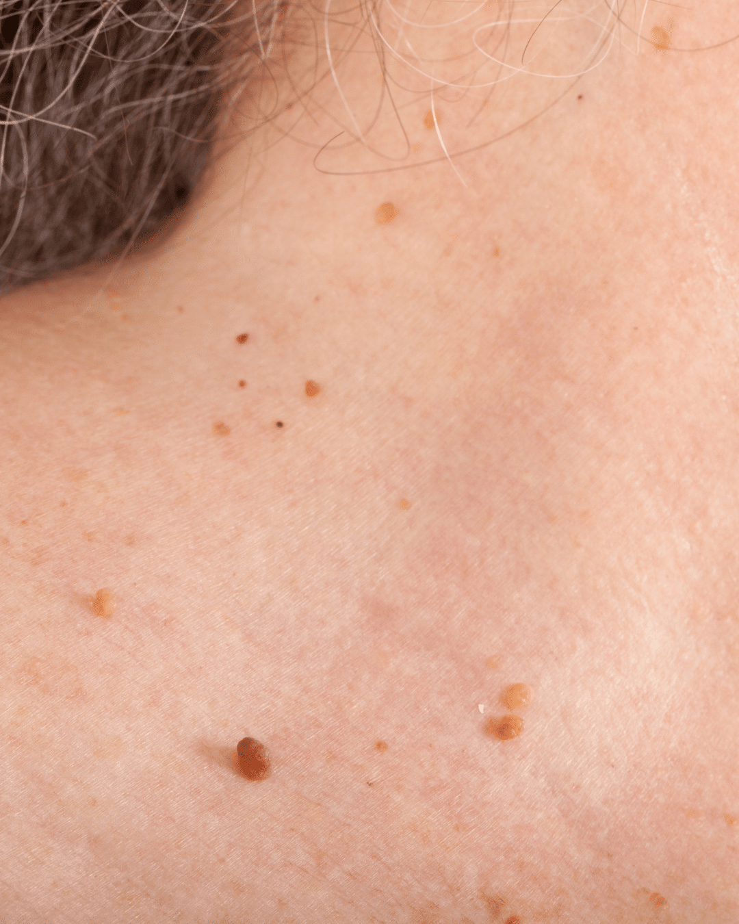 Skin Procedures in Bloomfield Hills, MI