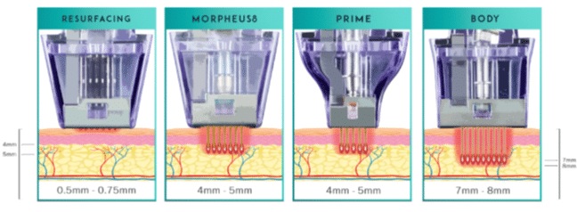 Morpheus8 Treatment Depths