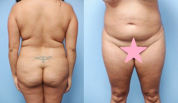 Pre-Op Body Contouring