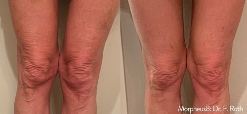 Morpheus8 Leg Treatment