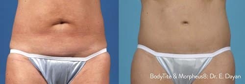Morpheus8 Abdominal Treatment
