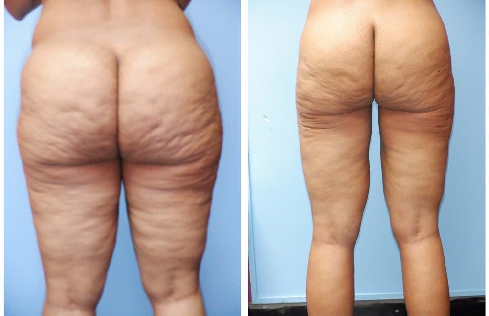 Lipotite - Morpheus 1 Treatment (back)