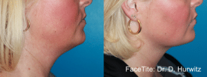 FaceTite™ in Bloomfield Hills, MI