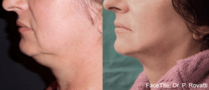 FaceTite™ in Bloomfield Hills, MI