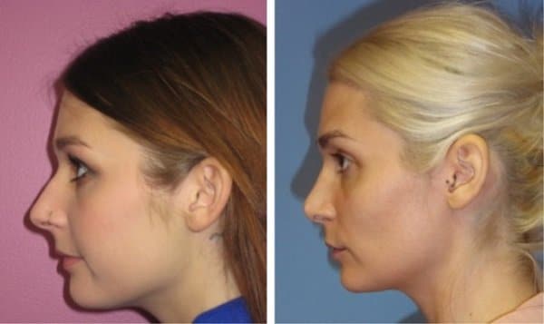 Rejuuuuve4You FaceTite Procedure