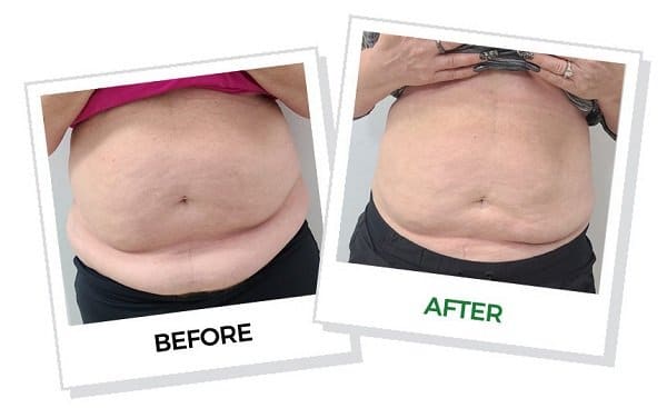 Emerald Laser Fat Loss