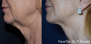 Neck Lift 2