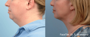 Neck Lift 4
