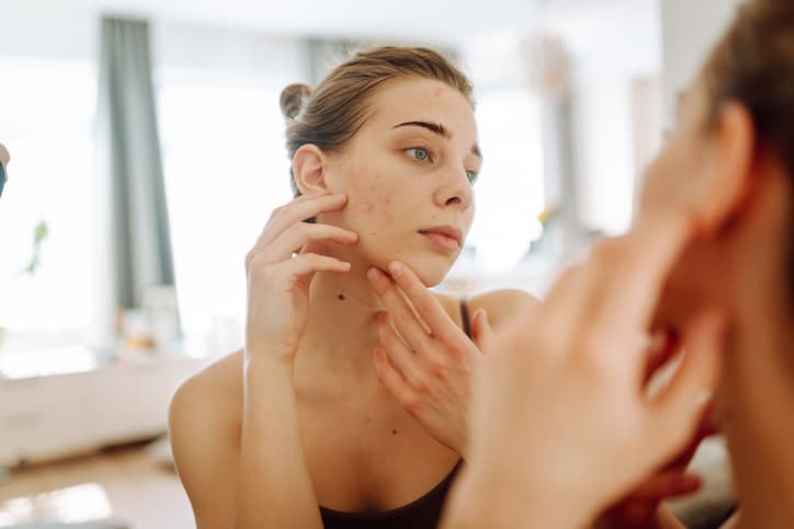 Acne Injections in Bloomfield Hills, MI
