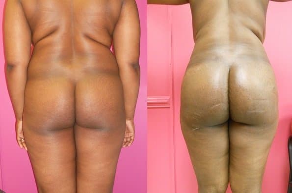Brazilian Butt Lift Rejuuuuve4You