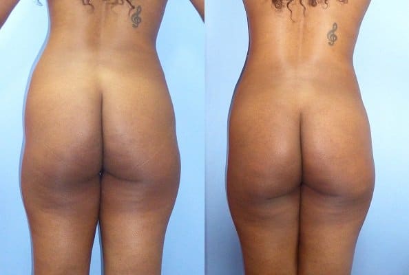 Brazilian Butt Lift Surgery in Bloomfield Hills, MI
