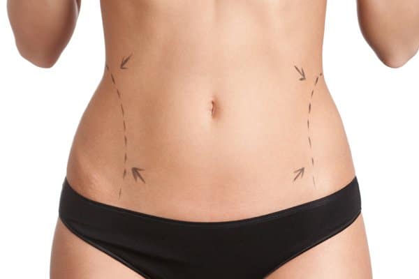 Liposuction in Bloomfield Hills, MI