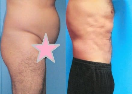 Liposuction in Bloomfield Hills, MI