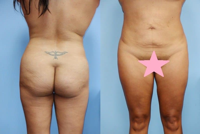 Liposuction in Bloomfield Hills, MI