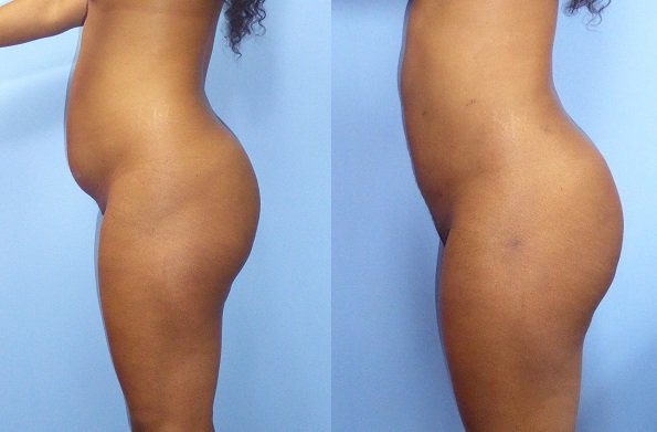 Liposuction in Bloomfield Hills, MI