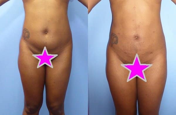 Liposuction in Bloomfield Hills, MI