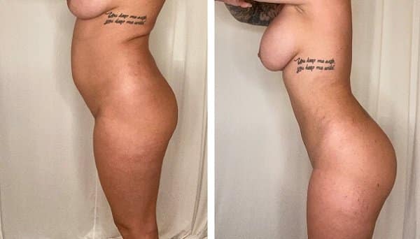 Liposuction in Bloomfield Hills, MI