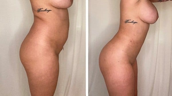 Liposuction in Bloomfield Hills, MI