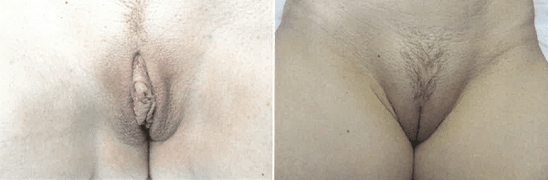 1778315681_Mons-Fat-Transfer-1 Mons Fat Transfer