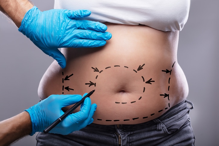Full Abdominoplasty in Bloomfield Hills, MI