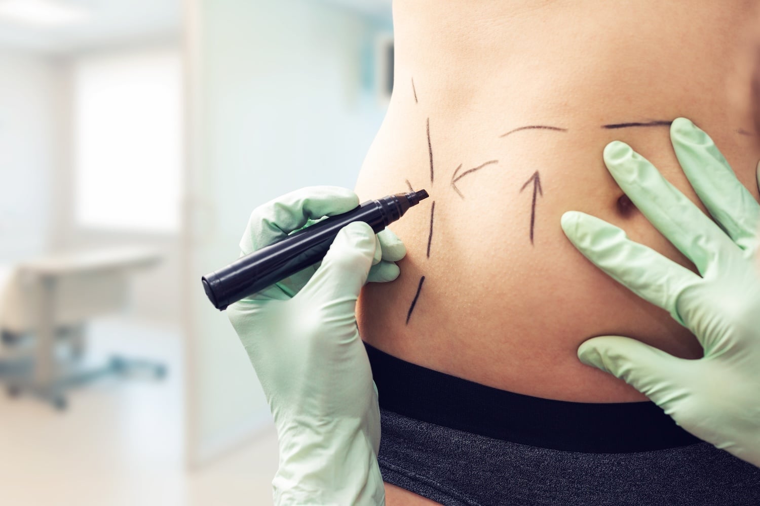 Mini Abdominoplasty in Bloomfield Hills, MI