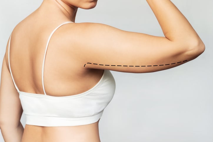Brachioplasty in Bloomfield Hills, MI