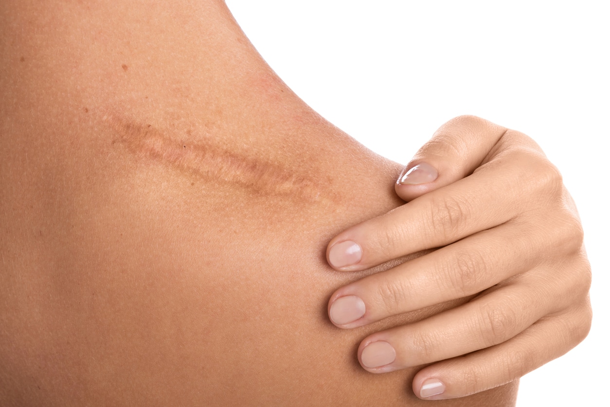 Scar Revision & Removal in Bloomfield Hills, MI