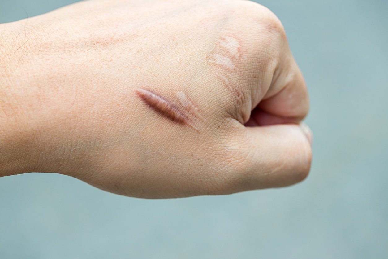 Keloid Revision in Bloomfield Hills, MI