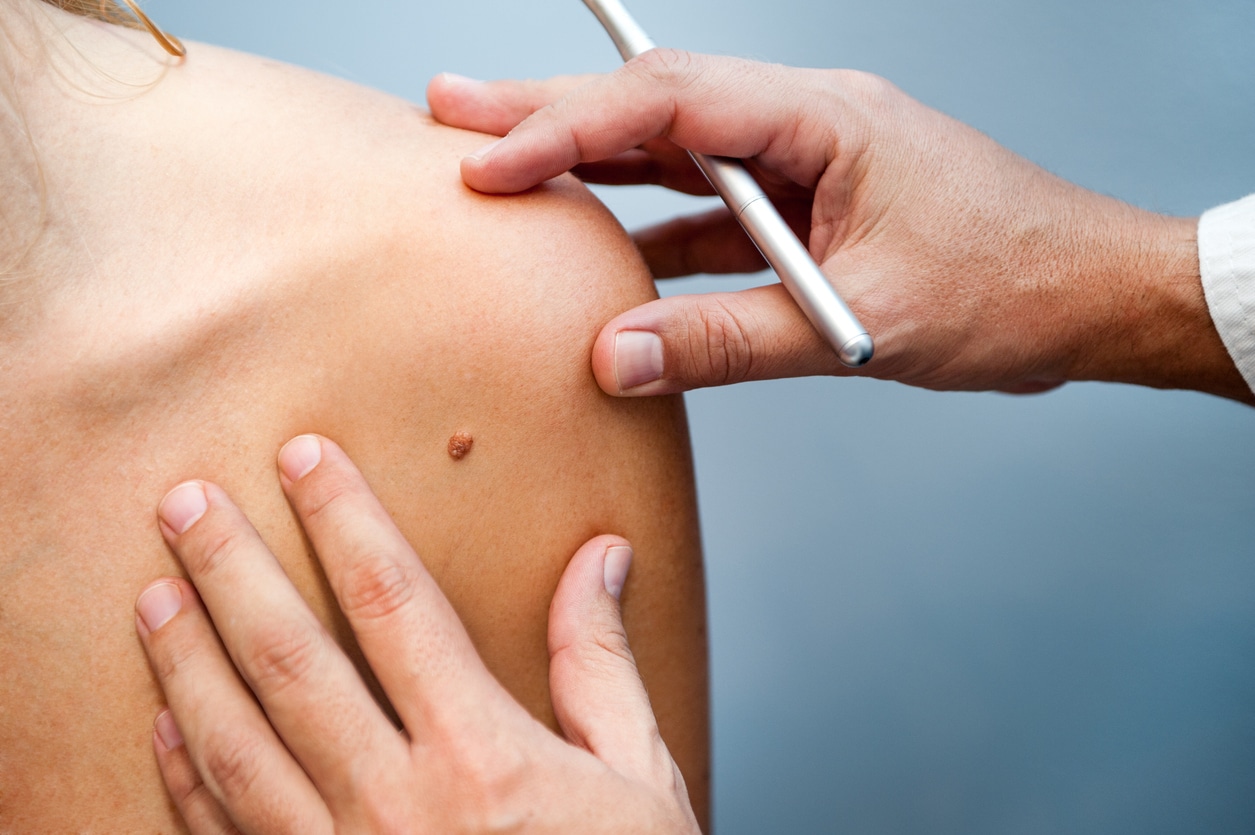 Lesion Revision in Bloomfield Hills, MI