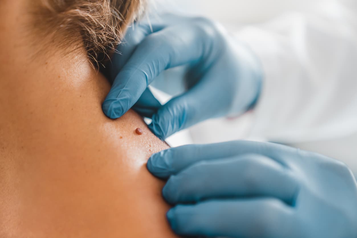 Mole Revision in Bloomfield Hills, MI
