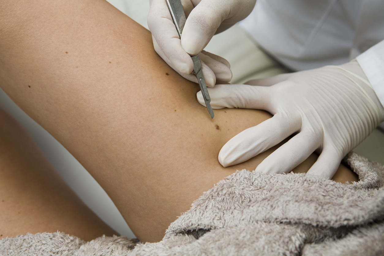 Nevi Revision in Bloomfield Hills, MI
