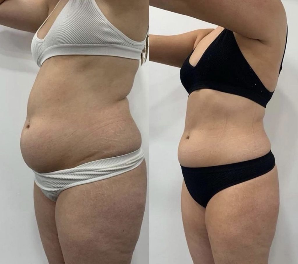 Before and After Image: Emerald - left-front-oblique